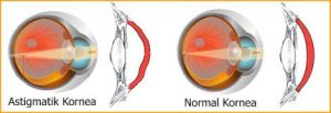 Astigmat Nedir?